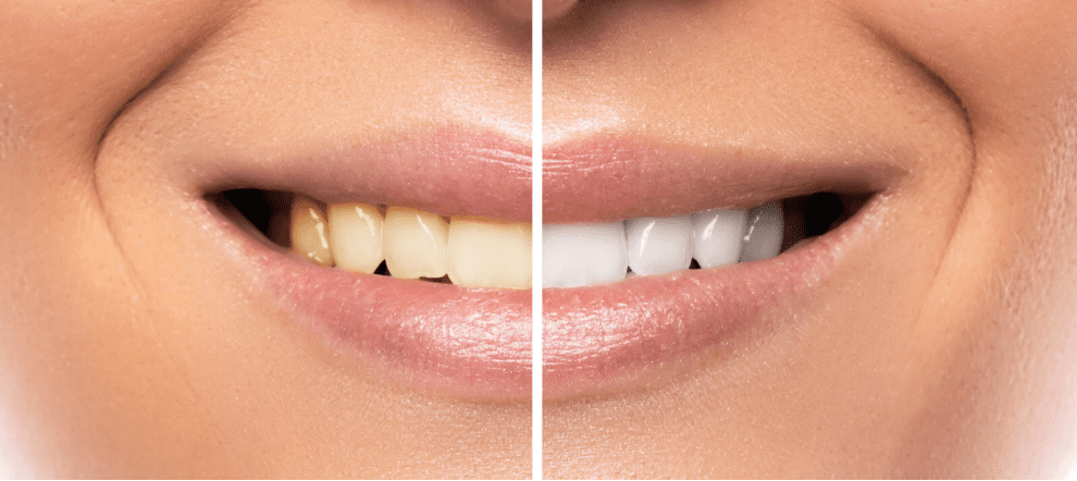 Tooth discoloration and illnesses La discromia dentale